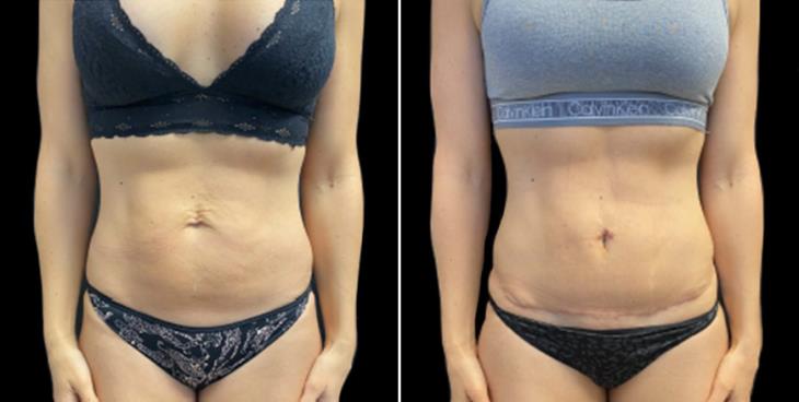 Marietta GA Abdominoplasty Surgery Results