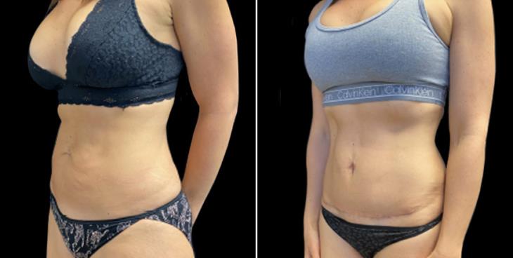 Abdominoplasty Surgery Results Marietta Georgia