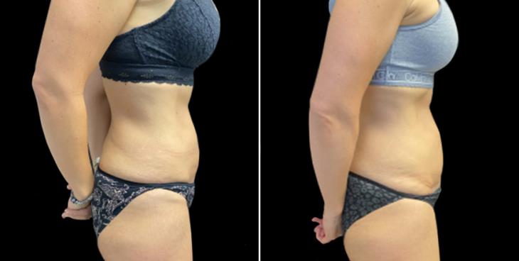 Atlanta Georgia Abdominoplasty Surgery Results