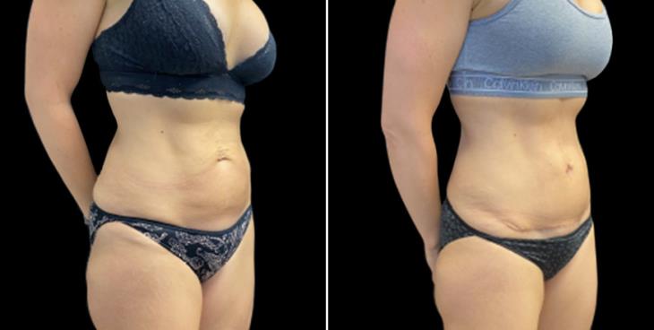 Abdominoplasty Surgery Results Atlanta Georgia