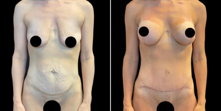 Cumming Abdominoplasty Surgery Results