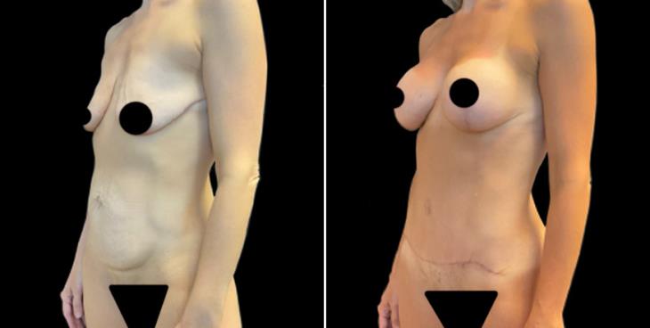 Abdominoplasty Surgery Results Cumming Georgia