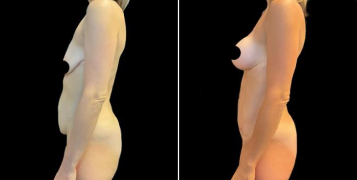 Cumming Georgia Abdominoplasty Surgery Results