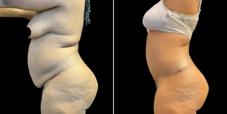 Abdominoplasty Surgery Results GA