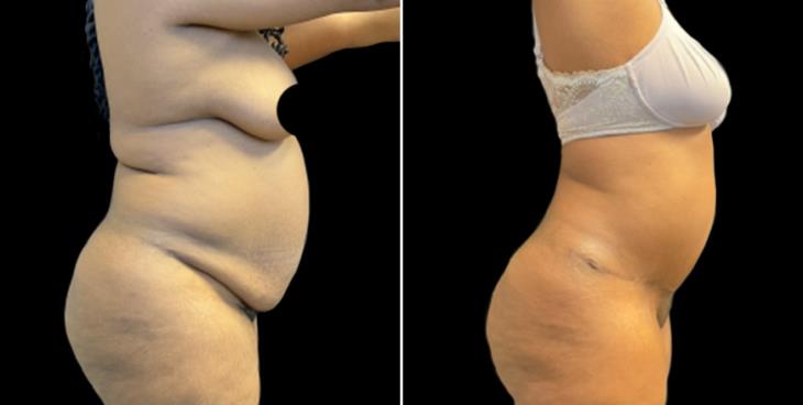 Abdominoplasty Surgery Before & After Georgia