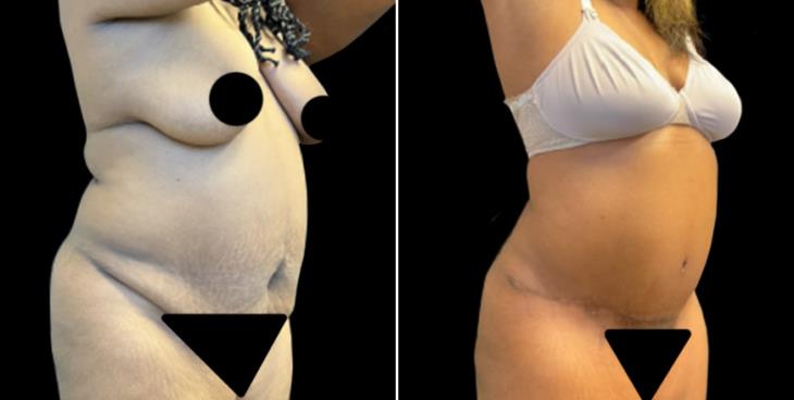 GA Abdominoplasty Surgery Results