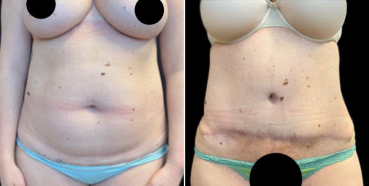 Georgia Abdominoplasty Surgery Before & After