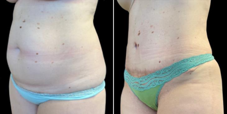 Abdominoplasty Surgery Before & After Atlanta