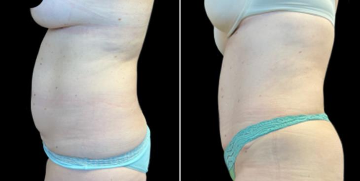 Atlanta Abdominoplasty Surgery Before & After