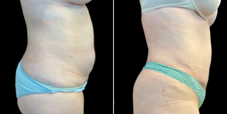 Atlanta GA Abdominoplasty Surgery Before & After