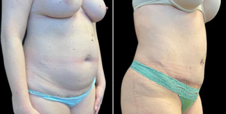 Abdominoplasty Surgery Before & After Atlanta GA