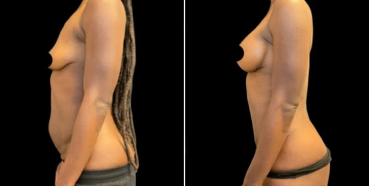 Abdominoplasty Surgery Before & After Marietta