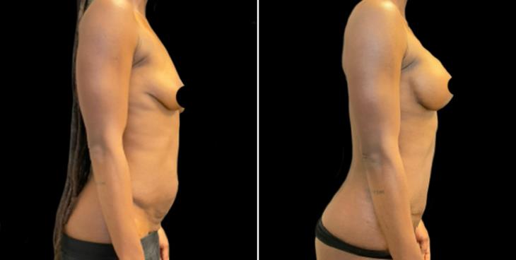 Abdominoplasty Surgery Before & After Marietta GA