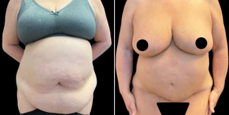 Marietta GA Abdominoplasty Surgery Before & After