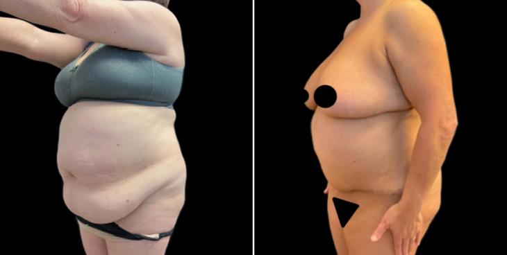 Abdominoplasty Surgery Before & After Marietta Georgia