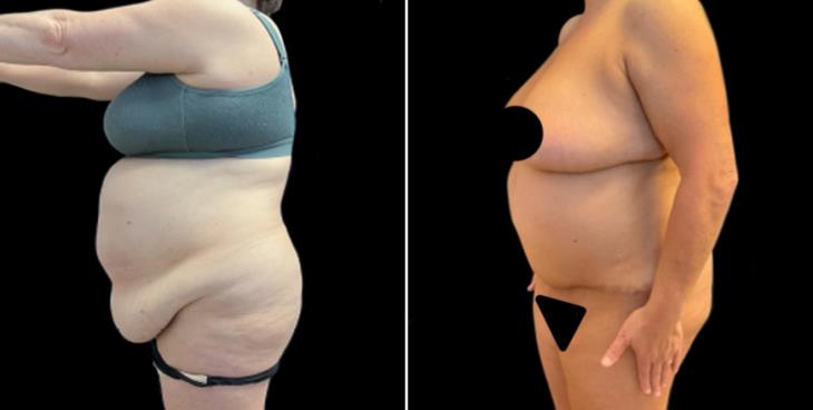 Marietta Georgia Abdominoplasty Surgery Before & After