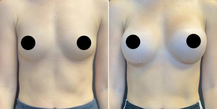 Breast Enhancement Results