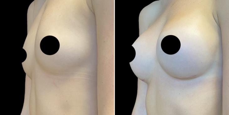 Breast Enhancement Results Atlanta