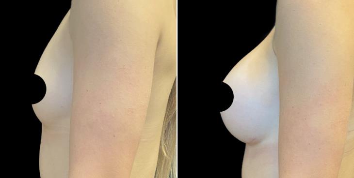 Results Of Breast Enhancement