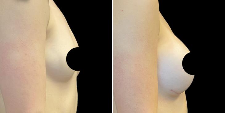 Breast Enhancement Results Atlanta GA