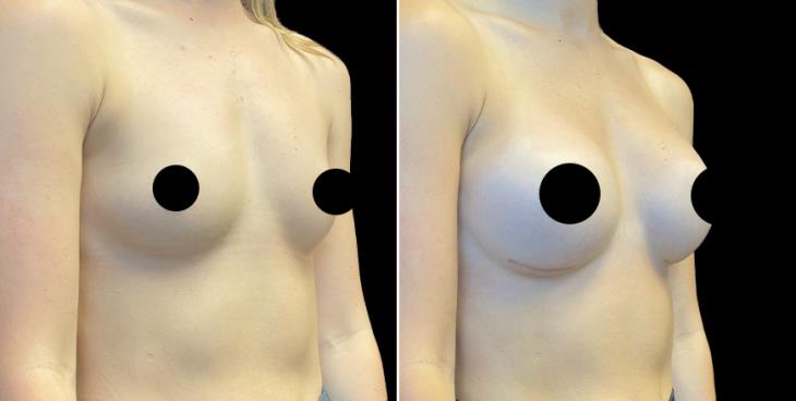 Atlanta Breast Enhancement Results