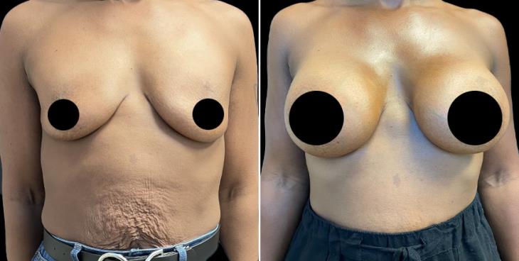 Atlanta GA Breast Enhancement Results
