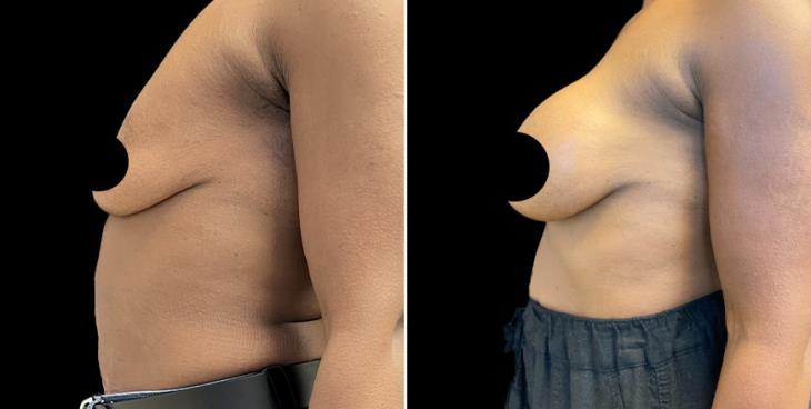 Results Of Breast Enhancement Atlanta GA