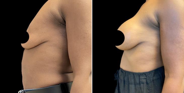 Results Of Breast Enhancement Atlanta GA
