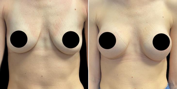Breast Enhancement Before And After
