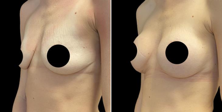 Breast Enhancement Before & After