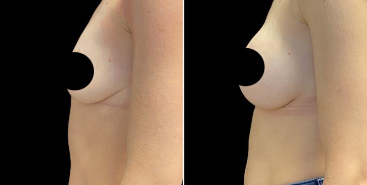 Before & After Breast Enhancement