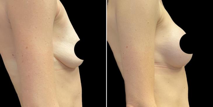 Atlanta Breast Enhancement Before And After