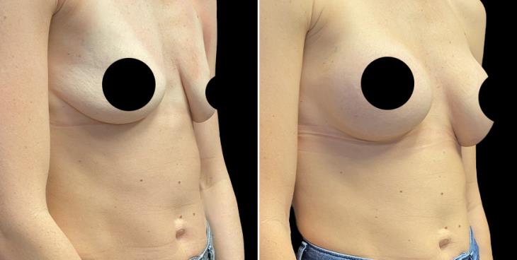 Before And After Breast Enhancement Atlanta