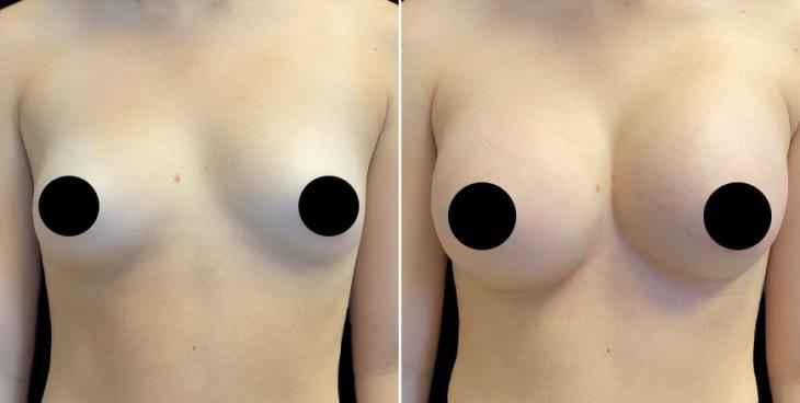 Breast Enhancement Before & After Atlanta