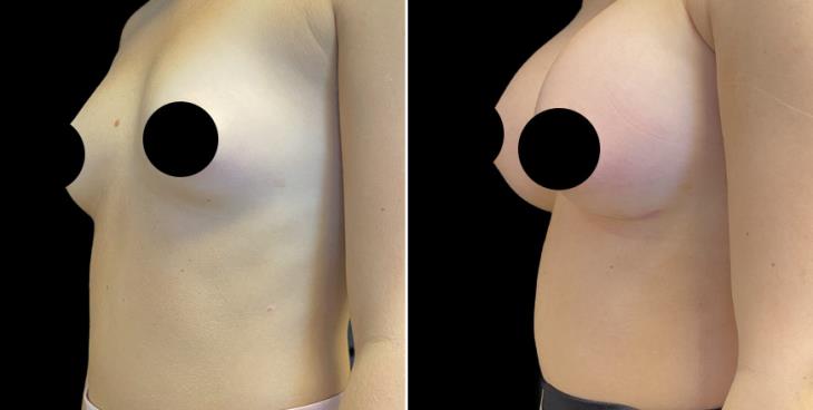 Breast Enhancement Georgia