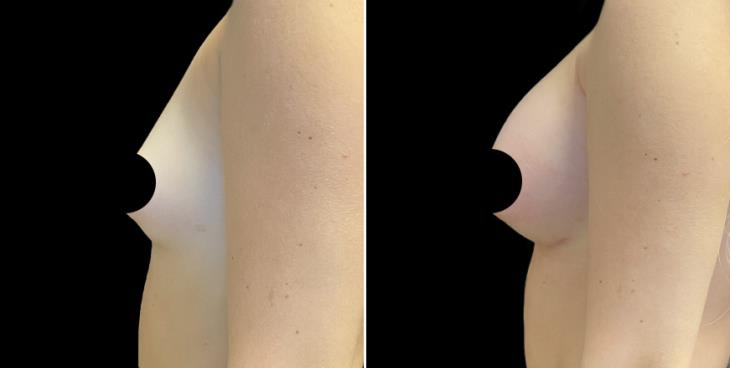 Before & After Breast Enhancement Atlanta