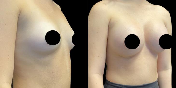 Breast Enhancement GA