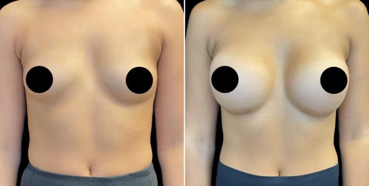 Georgia Breast Enhancement