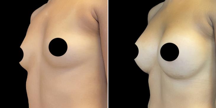 Breast Enhancement Marietta