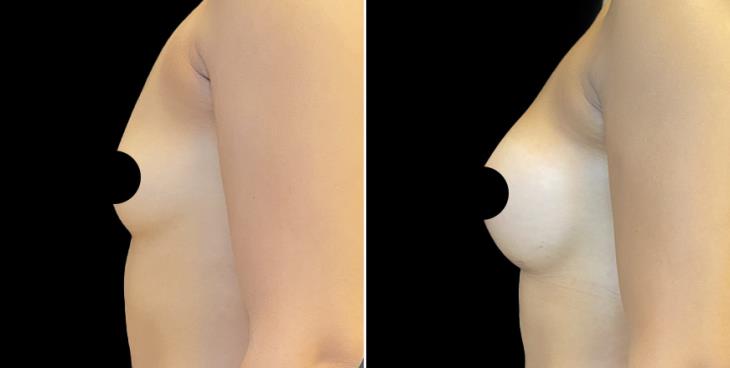 Marietta Breast Enhancement