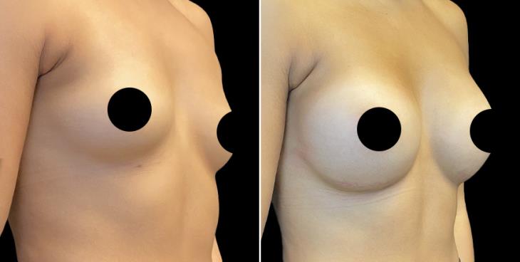 Breast Enhancement Cumming