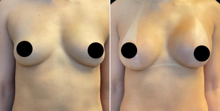 Breast Enhancement Cumming GA