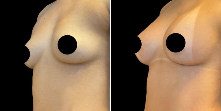 Breast Enhancement Marietta GA