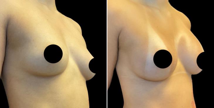 Marietta GA Breast Enhancement