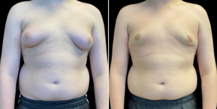 Results Of Gynecomastia Surgery