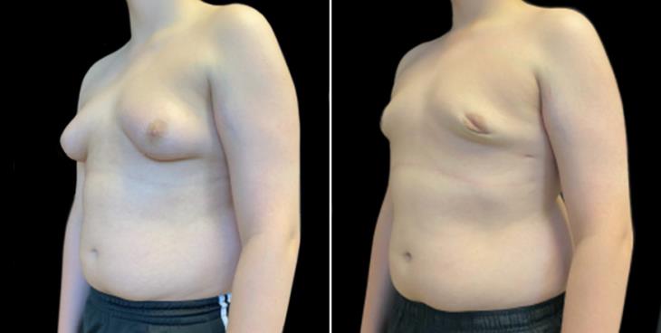 Gynecomastia Surgery Results Side View