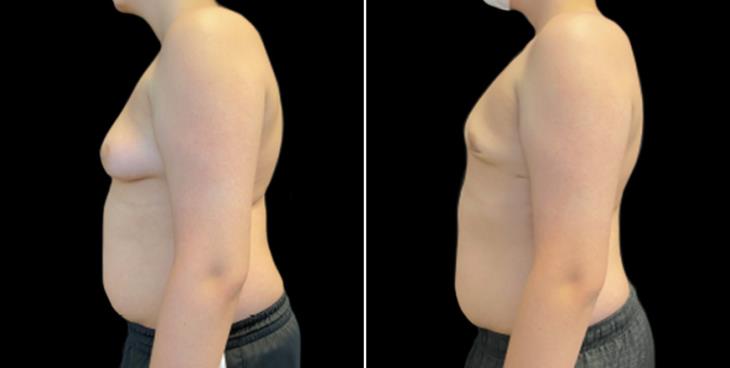 Gynecomastia Surgery Before & After