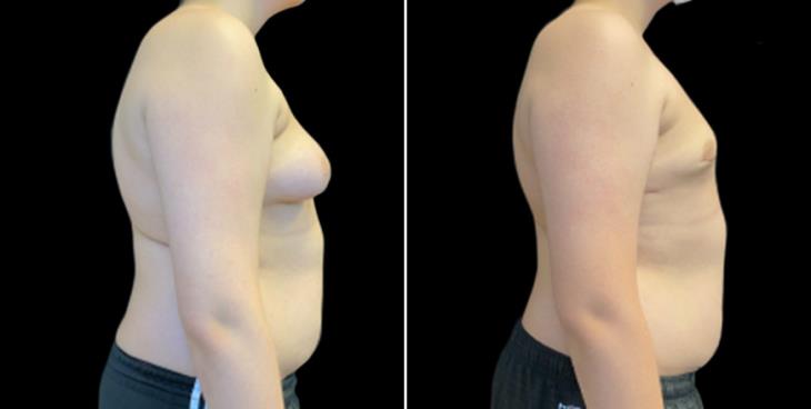 Before & After Gynecomastia Surgery