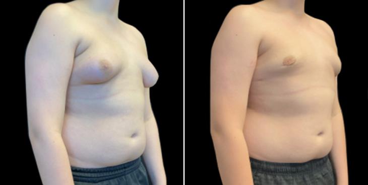 Side View Gynecomastia Surgery Results