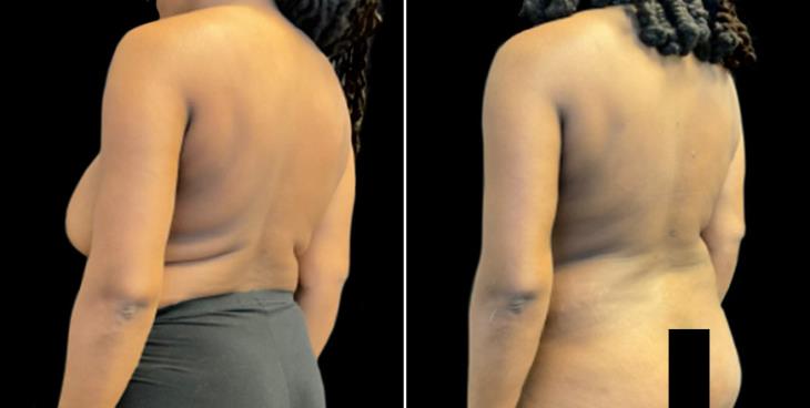 Atlanta Lipo Results